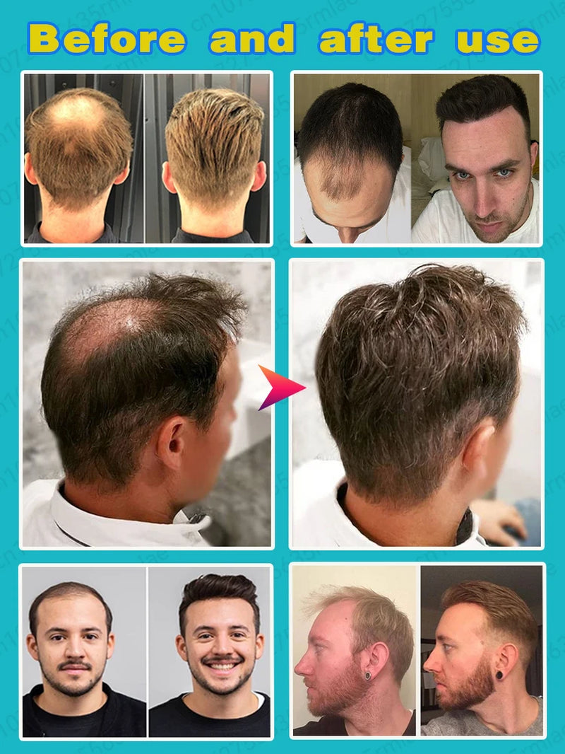 Essence De Croissance Des Cheveux，Quickly Repair Hair Loss and Say Goodbye to Baldness